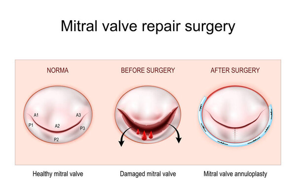 Mitral valve repair surgery. Healthy mitral valve. Damaged mitral valve before and after annuloplasty. vector illustration