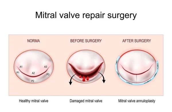 Mitrális Billentyű Műtét Egészséges Mitrális Billentyű Sérült Mitrális Billentyű Érplasztika Vektor Grafikák