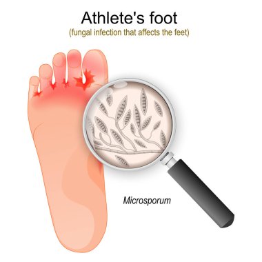 Atlet ayağı. Ayakları etkileyen mantar enfeksiyonu. Microsporum mantarlarına yakın çekim. vektör illüstrasyonu