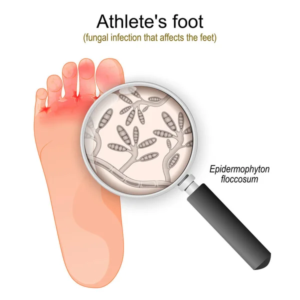 選手の足 足に影響する真菌感染症です エピデルモフィトンフロクサム真菌のクローズアップ ベクターイラスト — ストックベクタ