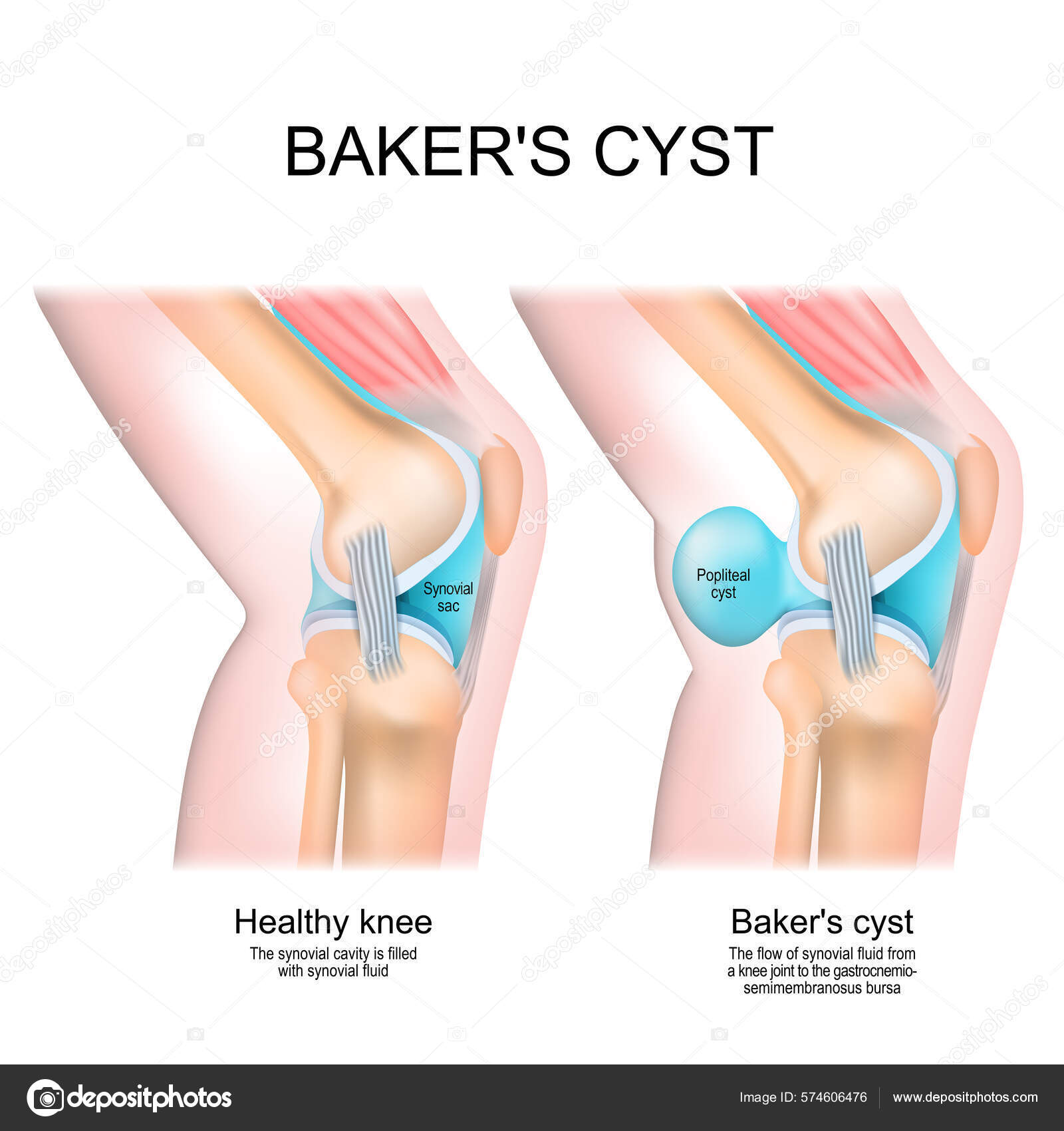 Baker's Cyst Normal Knee Joint Popliteal Cyst Flow Synovial Fluid Stock