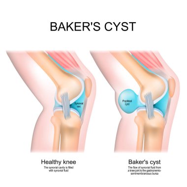 Baker's cyst. Normal knee, and joint with Popliteal cyst. The flow of synovial fluid from the knee joint to the gastrocnemio-semimembranosus bursa. vector illustration clipart