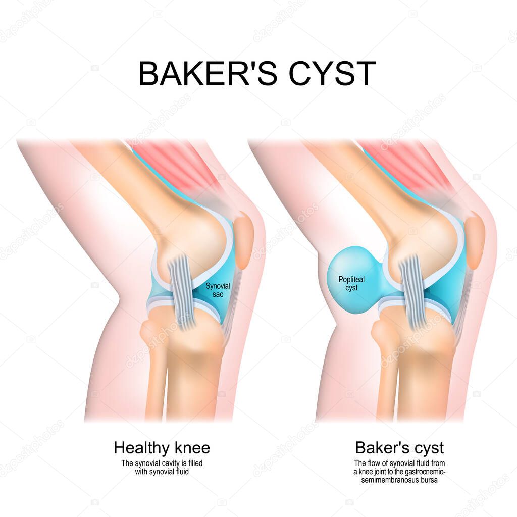 El quiste de Baker. Rodilla normal y articulación con quiste poplíteo