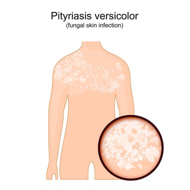 Tinea versicolor. Pityriasis versicolor belirtileri gösteren insan vücudu. Mantardan etkilenen derinin yakın çekimi. vektör illüstrasyonu