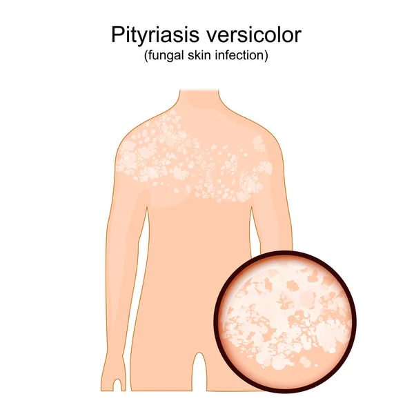 Tinea Versicolor Corpo Humano Com Sintomas Pitiríase Versicolor Close Pele —  Vetores de Stock