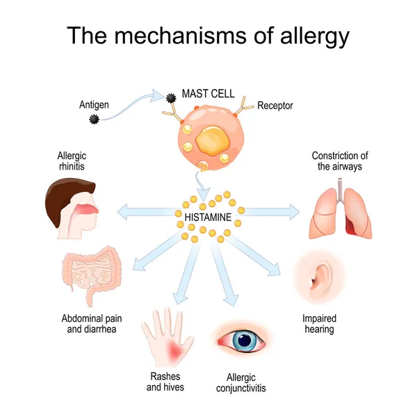 Mecanismo Alergia Mastocitos Reacción Alérgica Histamina Respuestas Inmunitarias Locales Ilustración — Vector de stock