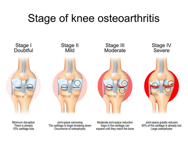 Stadia Van Knie Artrose Van Minimale Verstoring Tot Verlies Van — Stockvector