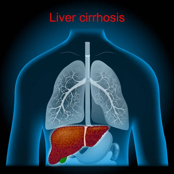 Een Cirrose Lever Hebben Schade Die Wordt Gekenmerkt Door Vervanging — Stockvector