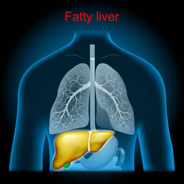 脂肪肝疾患 肝性狭窄 余分な脂肪は肝臓 肺にX線青色の現実的な胴に蓄積します 暗い背景に人間のシルエット ベクターポスター — ストックベクタ