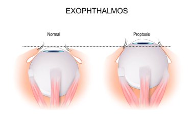 Exophthalmos, gözün yörüngenin dışında bir çıkıntı. Grave Hastalığı 'nın neden olduğu normal göz küresi ve bozukluk arasındaki karşılaştırma ve fark. vektör illüstrasyonu