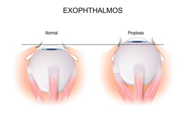 Exophthalmos is a bulging of the eye anteriorly out of the orbit. comparison and difference between normal eyeball and disorder that caused by Grave's Disease. vector illustration clipart