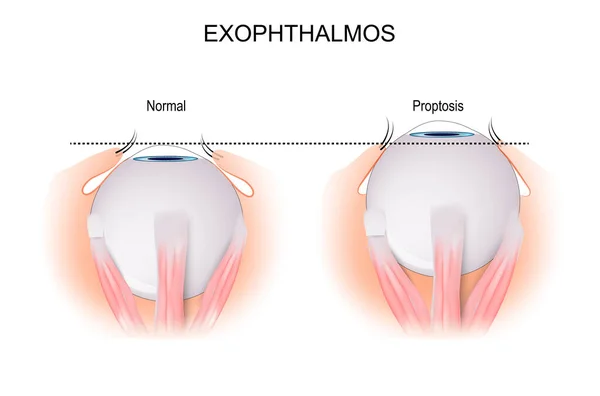 Exophthalmos Bulging Eye Anteriorly Out Orbit Comparison Difference Normal Eyeball — Stock Vector