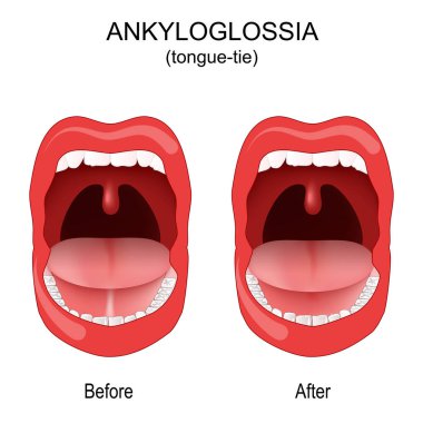 Ankyloglossia. Dil bağı. Doğuştan gelen oral anormallik. Dilin alt kısmını ağzın zeminine bağlayan kısa ve kalın bir franulum. Ameliyattan önce ve sonra. vektör illüstrasyonu