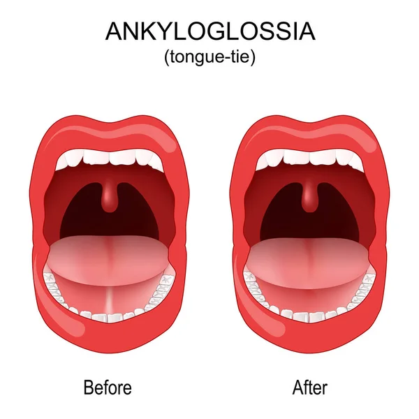 Ankyloglossia 입니다 묶는다 선천적 이상이야 말해서 아랫면 바닥을 연결하는 광등이다 — 스톡 벡터