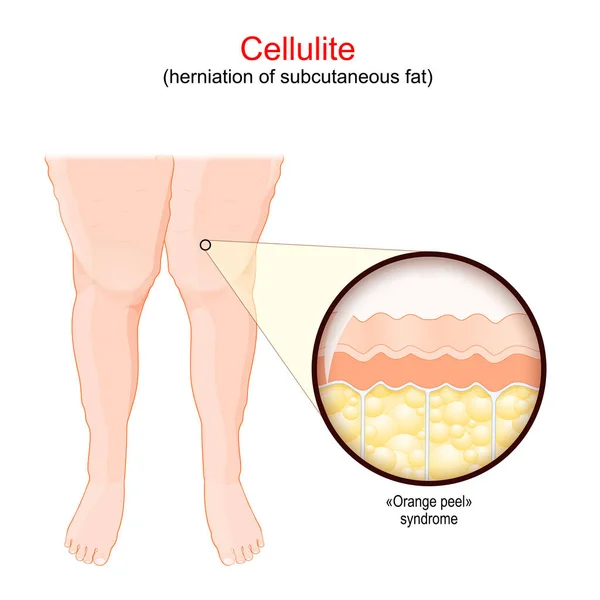 セルライト アディポシス エデマトサと女性の足 オレンジピール症候群と人間の皮膚のクローズアップ 皮下脂肪の造血 ベクターイラスト — ストックベクタ