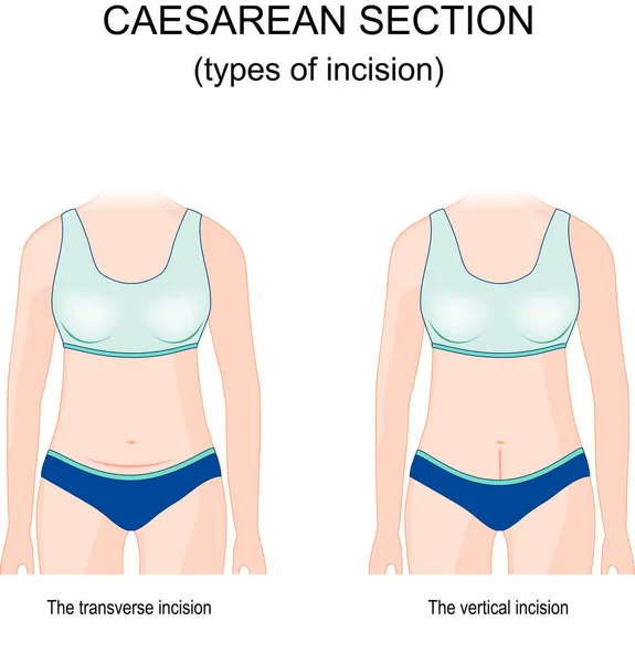 Césarienne Types Incision Sutures Horizontales Verticales Incision Verticale Incision Abdominale — Image vectorielle