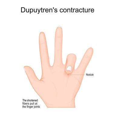 Dupuytren kasılması. Parmak avuç içine doğru eğil. Dupuytren hastalığı sol elde. Fibrosing bozukluğu palmar fasyasında kalınlaşmaya ve kısalmaya neden olur ve dijital kasılmalara yol açar. Vektör