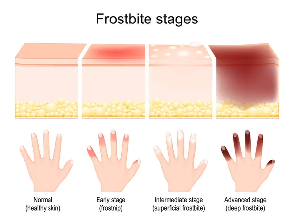 Stades Gelure Les Symptômes Sont Cours Comparaison Des Lésions Cutanées — Image vectorielle