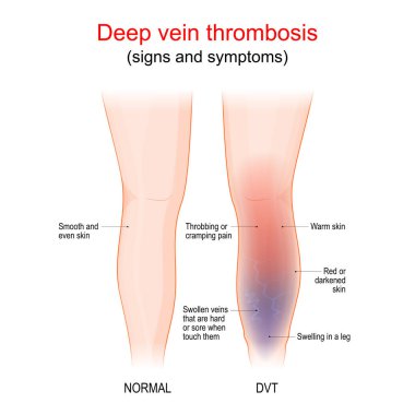 deep vein thrombosis is a blood clot in a vein, usually the leg. Healthy leg, and leg with DVT. Sign and symptoms of thrombophlebitis. Blood vessels disease. Vector illustration