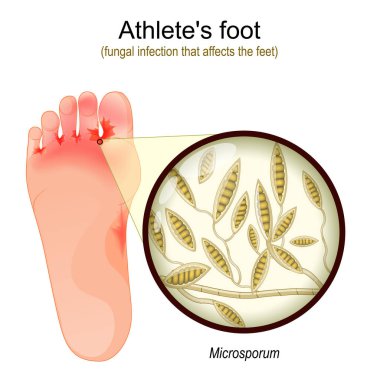 Athlete's foot. fungal infection that affects the feet. Close-up of yeast that causes infection disease of skin. Microsporum. vector illustration