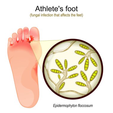 Athlete's foot. fungal infection that affects the feet. Close-up of yeast that causes infection disease of skin. Epidermophyton floccosum. vector illustration