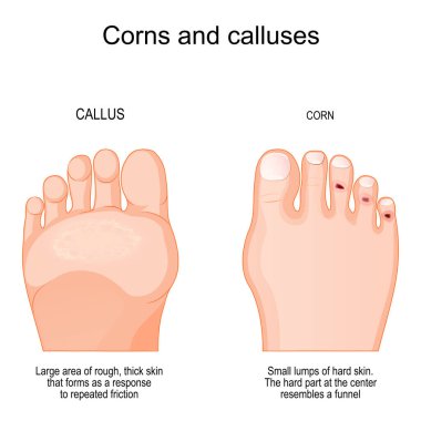 Corns on toe and calluses on sole. comparison and differences humans feet with corns and callus. Large area and Small lumps of rough, thick skin that forms as a response to repeated friction. vector illustration