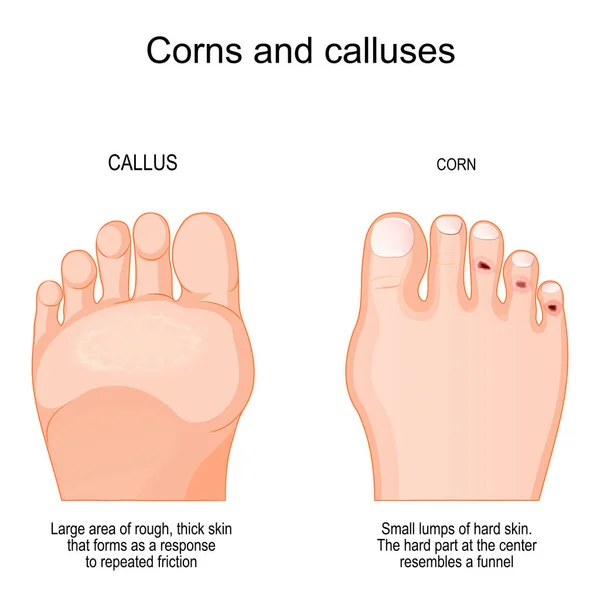 Corns Toe Calluses Sole Comparison Differences Humans Feet Corns Callus — Wektor stockowy