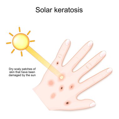 Güneş keratozu. Güneş tarafından hasara uğrayan kuru pullu deri parçaları. Güneşten sonra kurdeşen döken insan avucu. vektör illüstrasyonu
