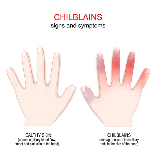 Chilblains Human Hand Symptoms Pernio Damaged Occurs Capillary Beds Skin — Stockový vektor