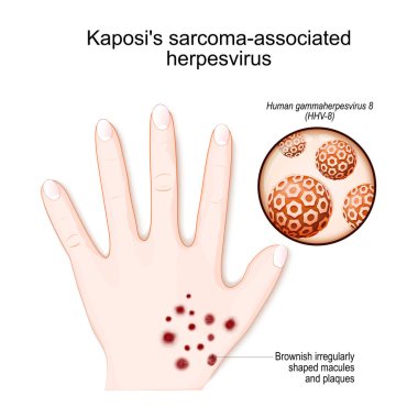 Kaposi 'nin sarkomla ilişkili herpesvirüsü. Kahverengimsi şekilli maküle ve plaklara sahip bir insan eli. İnsan gammaherpesvirüsüne (HHV-8) yakın çekim. vektör illüstrasyonu