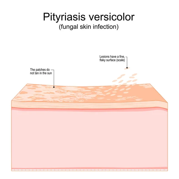 Pitiríase Versicolor Infeção Fúngica Pele Secção Transversal Uma Pele Humana — Vetor de Stock