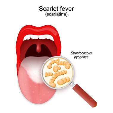 Kızıl hastalığı. Dilinde hastalık belirtileri olan bir çocuk ağzı. Streptococcus Pyogenes kolonisine yakın çekim. Scarlatina 'ya sebep olan büyüteç ve bakteriler. Vektör illüstrasyonu