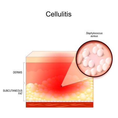 Selülit. İnsan derisinin katmanlarında bulaşıcı hastalık belirtileri var. Staphylococcus aureus 'a yakın çekim. bakteriyel enfeksiyon. Derinin iç katmanlarını kapsayan bakteriler. Dermatoloji. vektör illüstrasyonu