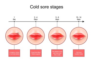 Cold sore stages. Lips with symptoms of Herpes labialis. scale From burning feeling to blisters formation and Cold sore location heals. vector infographics clipart