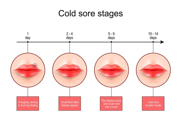 Cold Sore Stages Lips Symptoms Herpes Labialis Scale Burning Feeling — Stock vektor