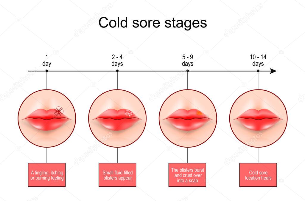 Cold sore stages. Lips with symptoms of Herpes labialis. scale From burning feeling to blisters formation and Cold sore location heals. vector infographics
