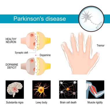 Parkinson's disease Infographic. Healthy neuron, and Synaptic cleft with dopamine deficit. Symptoms of a parkinsonism. Tremor or hands shaking. Muscle rigidity, Brain cell death, Lewy body and Substantia nigra. Vector poster and medical materials for