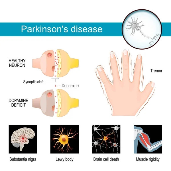 Parkinson Disease Infographic Healthy Neuron Synaptic Cleft Dopamine Deficit Symptoms — Vetor de Stock