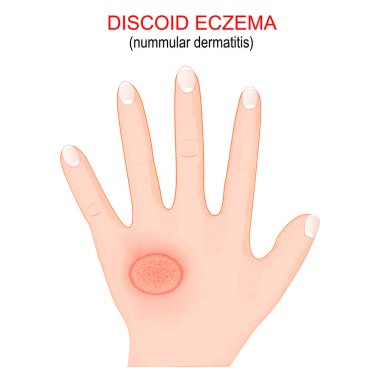 Nummular dermatitis. Discoid eczema is a chronic skin condition that causes skin to become itchy, swollen and cracked incircular patches. Close-up of a Humans hand with symptoms of disease. Vector poster clipart