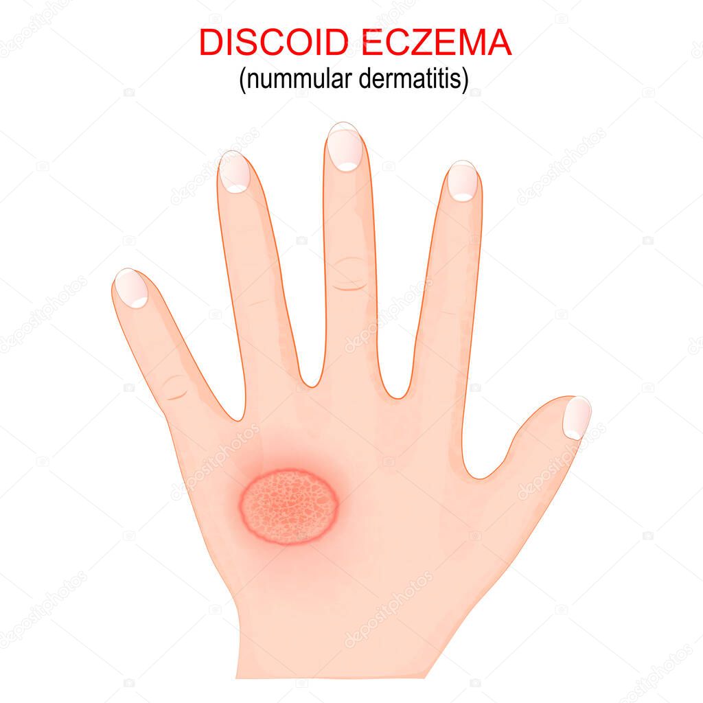 Nummular dermatitis. Discoid eczema is a chronic skin condition that