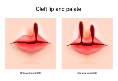 Cleft lip and cleft palate. face of a child with a defect cleft. Hare-lip. Unilateral and bilateral complete. Vector poster clipart
