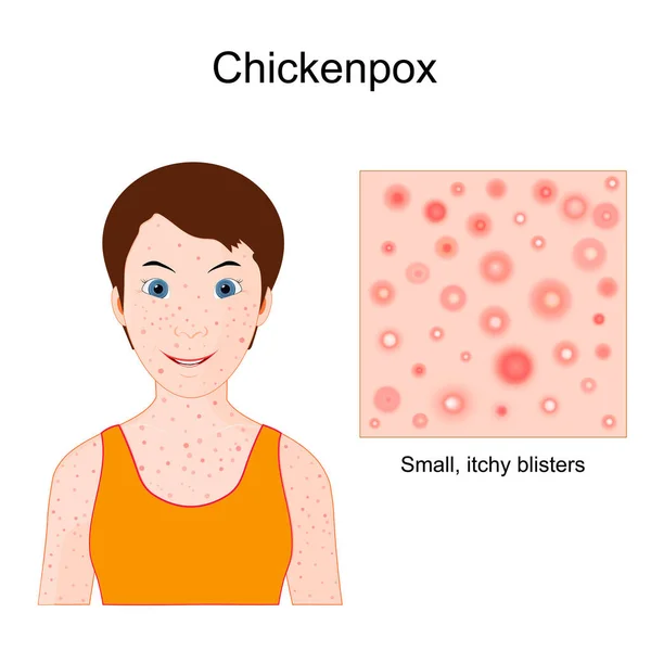 Chickenpox Varicella Face Child Skin Rash Close Skin Small Itchy — Stock vektor