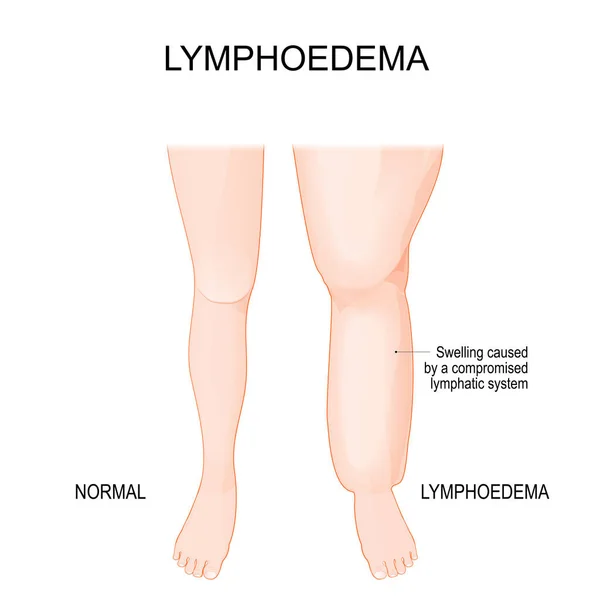 Lymphedema Lower Extremity Lymphatic Obstruction Comparison Difference Healthy Leg Leg — Vector de stock