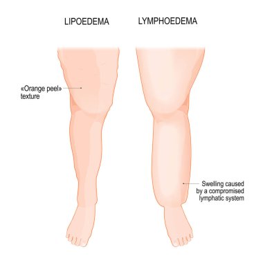 Lenf kanseri ve Lipoödem. Lipedema bacağının karşılaştırılması ve farklılığı ve lenfatik yetersizlikle birlikte bacağı. Fazla kilolu. Lipoödem, bacaklarda anormal bir yağ birikimi, portakal kabuğu derisi. Lenf kanseri. Lenfatik sistemde düzensizlik. Vektör po