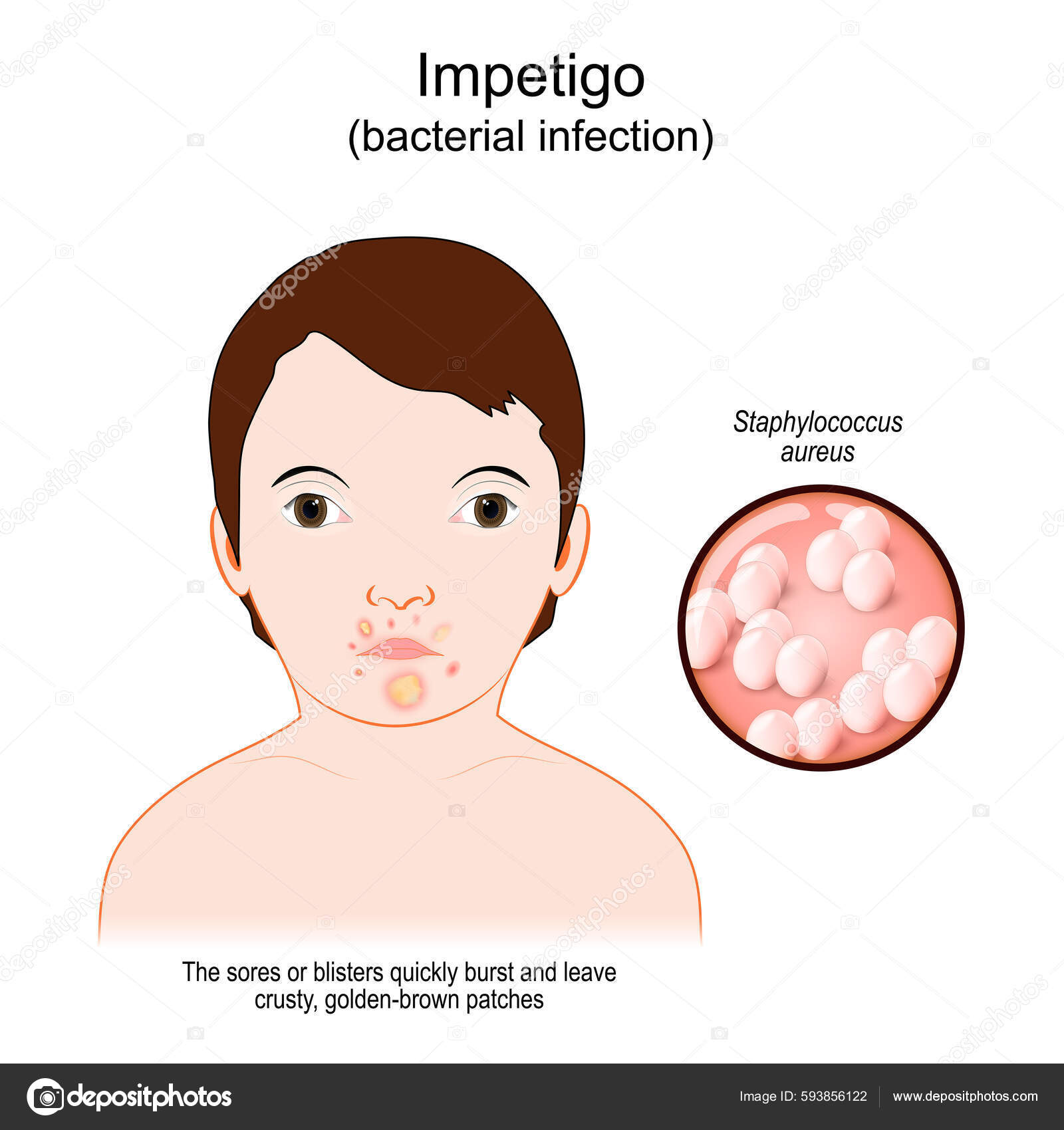 Impetigo Bacterial Infection Face Baby Skin Infection Mouth Sores