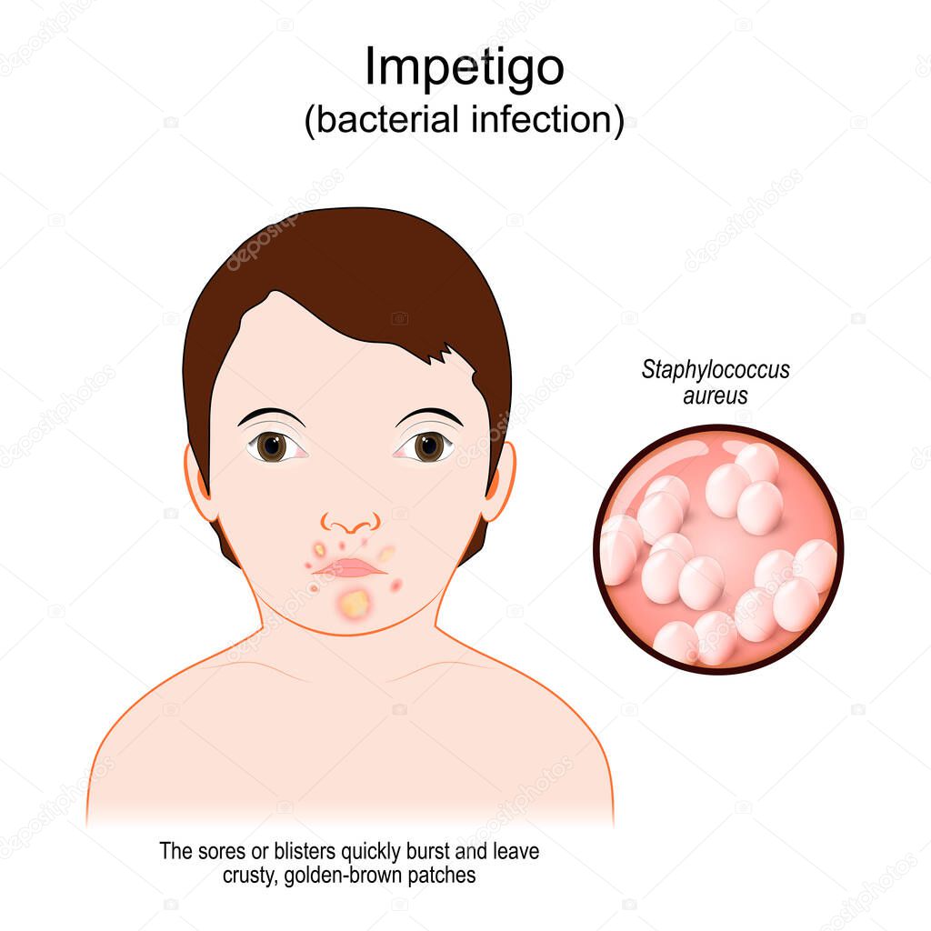 Impetigo. bacterial infection. Face baby with a skin infection around the mouth. The sores or blisters quickly burst and leave crusty, golden-brown patches. Close-up of a bacteria Staphylococcus aureus. Vector poster