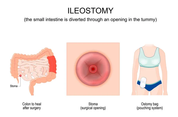 Ileostomy Small Intestine Diverted Opening Tummy Colon Heal Surgery Close — Vector de stock