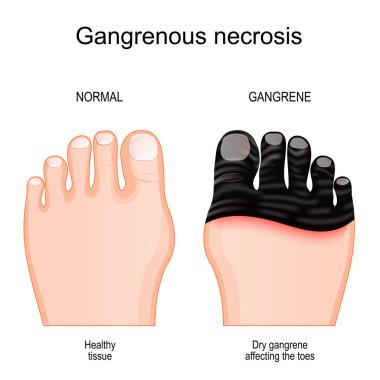 Gangrene. Comparison and difference between healthy foot and leg with tissue death by Gangrenous necrosis. Dry gangrene affecting the toes. Vector poster clipart