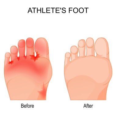Athlete's foot is a fungal infection that affects the feet. Comparison and difference. Humans feet before and after therapy. vector poster