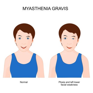 Myasthenia gravis. Girl with neuromuscular disease. patient with ptosis and Left lower facial weakness. Symptoms of Autoimmune disease. Vector poster